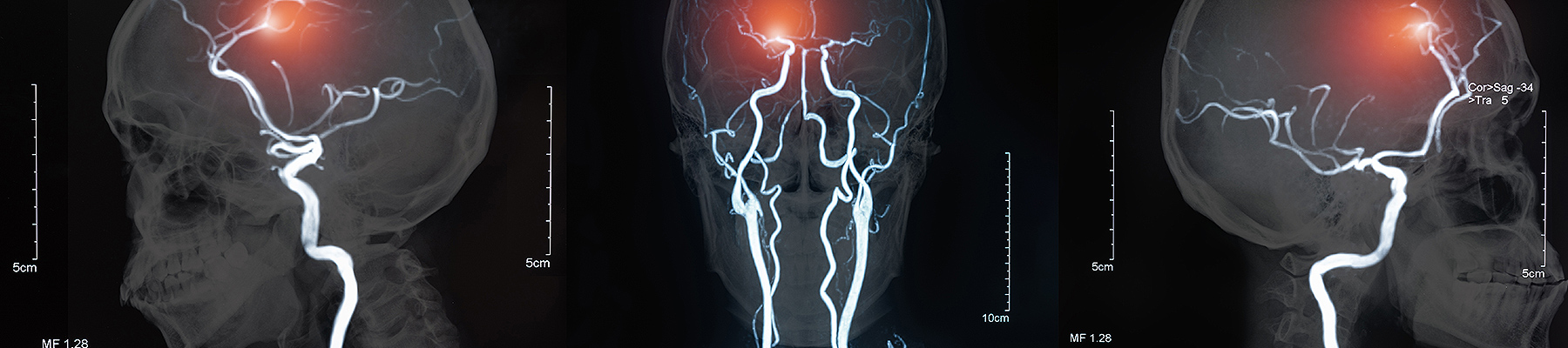 Types of Stroke