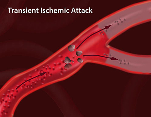 Transient Ischemic Attack