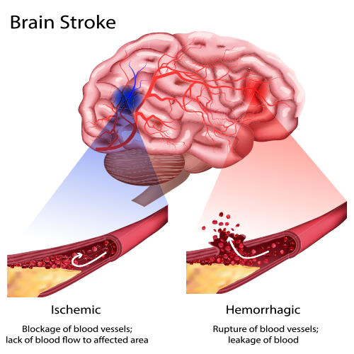 Types of Stroke